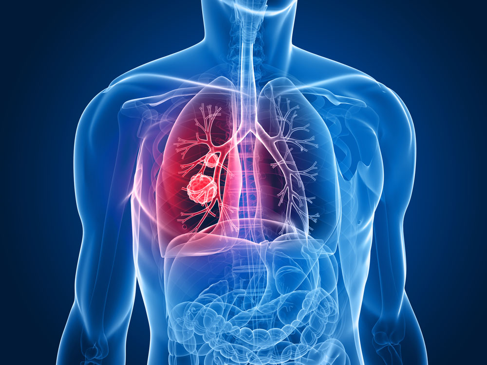 肺癌的并发症都有哪些？