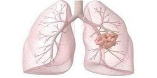 印度奥希替尼能部分延长肺癌患者的生命