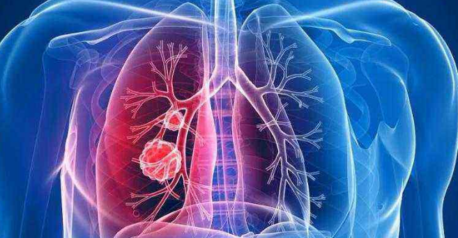 特罗凯+贝伐珠单抗可能成为新的肺癌一线治疗药物