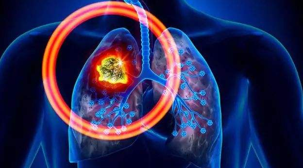 厄洛替尼 患者服用厄洛替尼需要戒烟吗?