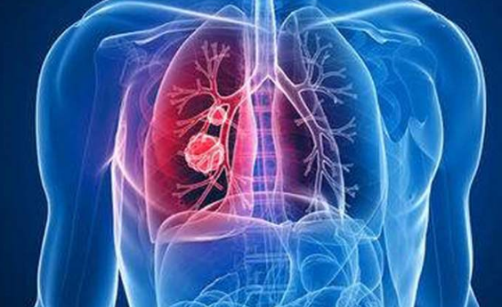 三代肺癌靶向药在治疗的时候该如何选择呢？