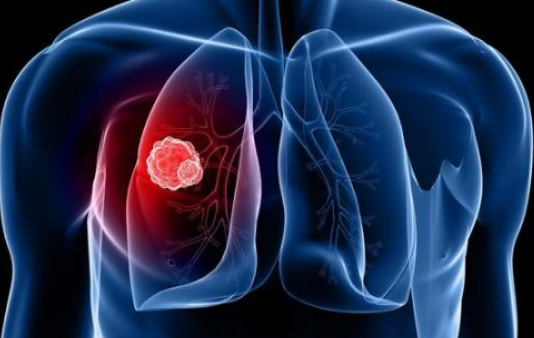 晚期肺癌患者用帕博利珠单抗治疗5年生存率将提高3倍！