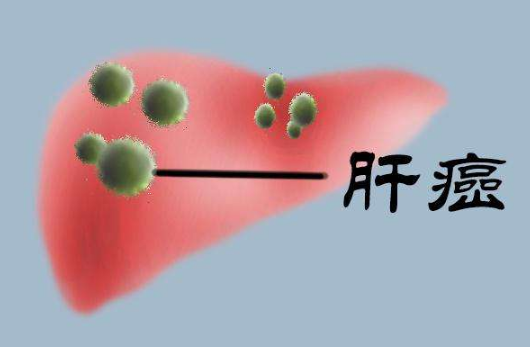 这些症状是肝癌的警示