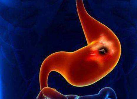 雷莫芦单抗 雷莫芦单抗是胃癌患者的新选择