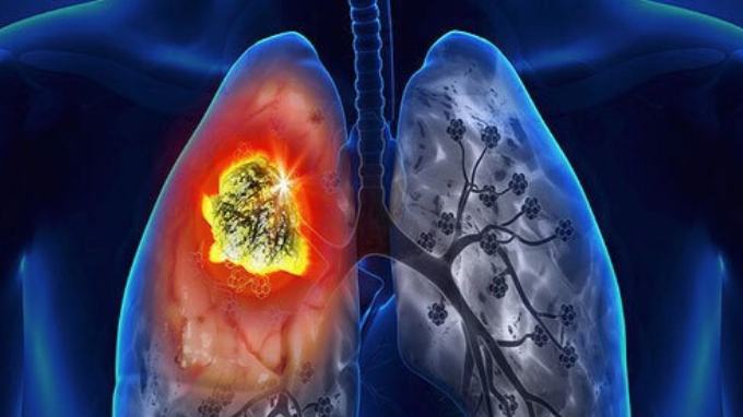 非小细胞肺癌靶向治疗后耐药了？怎么办？您想知道的都在这！