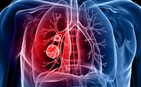 中期肺癌能治愈吗？肺鳞癌中期平均生存期较普遍的情况是多长？