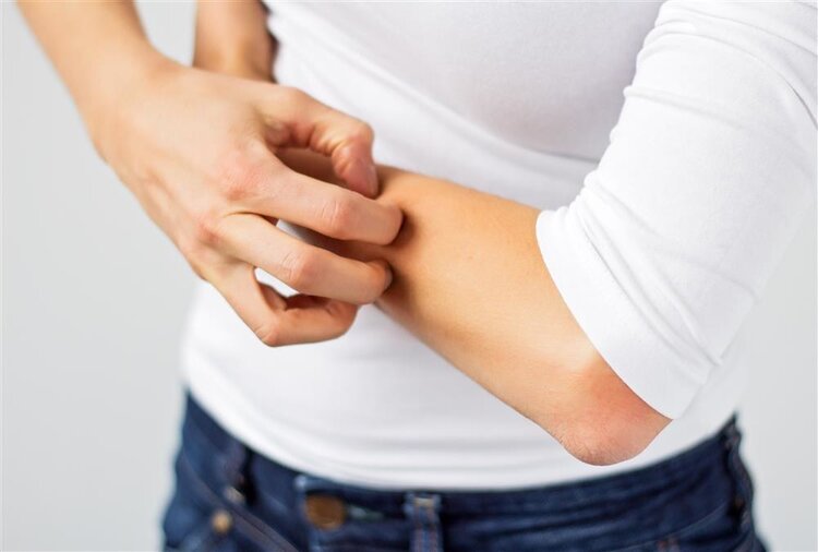 银屑病不仅仅是皮肤病，还要小心关节炎