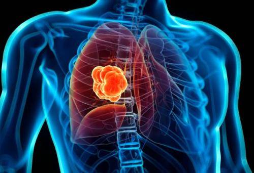 1617694875205807.jpg 骨转移药地舒单抗(安加维)VS唑来膦酸疗效哪个更好?