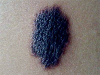 黑色素瘤 曲美替尼联合达拉非尼治疗晚期黑色素瘤生存期延长5年