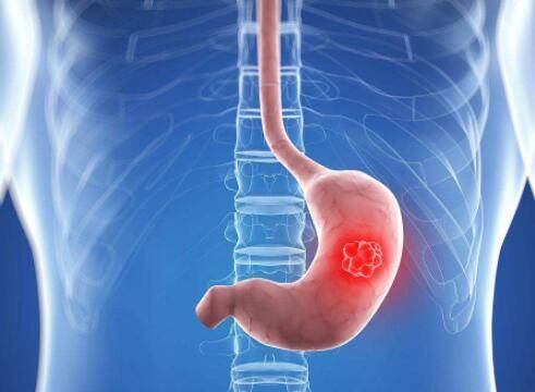 胃癌 维迪西妥单抗(爱地希®️)治疗HER2中高表达晚期胃癌疗效显著