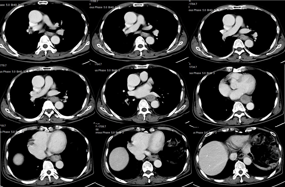 1621842946591467.png 晚期食管癌免疫治疗:雷替曲塞+PD-L1(转)