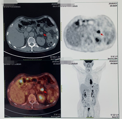 1621843046618796.png 晚期食管癌免疫治疗:雷替曲塞+PD-L1(转)