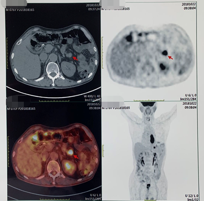 1621843055780389.png 晚期食管癌免疫治疗:雷替曲塞+PD-L1(转)