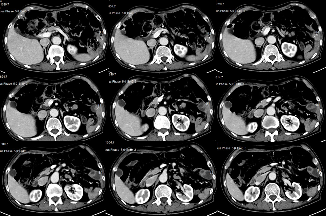 1621842961735185.png 晚期食管癌免疫治疗:雷替曲塞+PD-L1(转)
