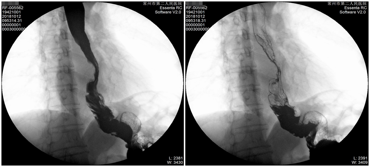 1621842933608150.png 晚期食管癌免疫治疗:雷替曲塞+PD-L1(转)