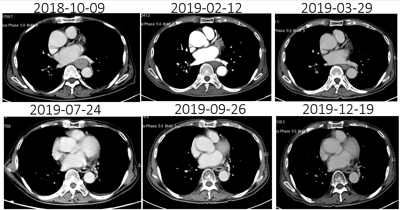 1621843159833154.png 晚期食管癌免疫治疗:雷替曲塞+PD-L1(转)