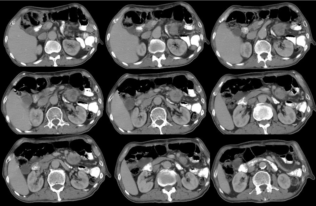 1621843096523145.png 晚期食管癌免疫治疗:雷替曲塞+PD-L1(转)