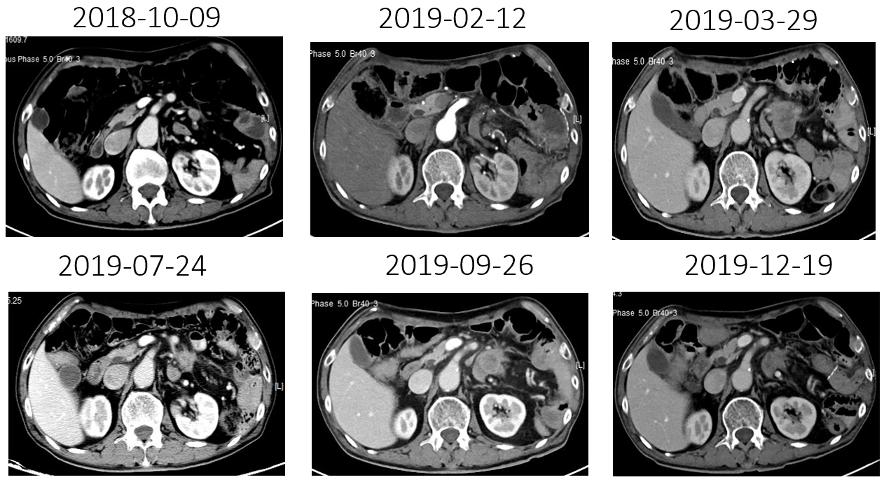 1621843178447510.png 晚期食管癌免疫治疗:雷替曲塞+PD-L1(转)