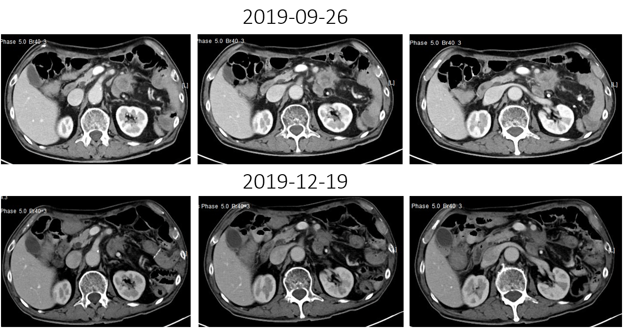 1621843187881183.png 晚期食管癌免疫治疗:雷替曲塞+PD-L1(转)