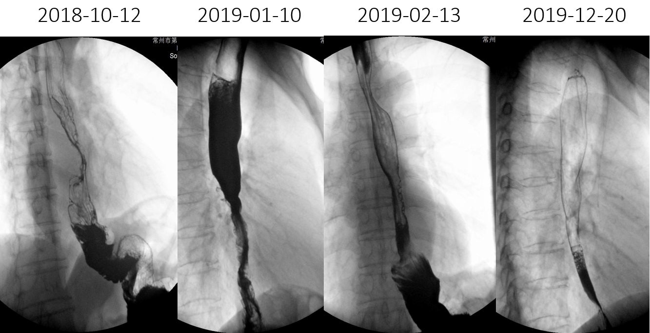 1621843170491834.png 晚期食管癌免疫治疗:雷替曲塞+PD-L1(转)