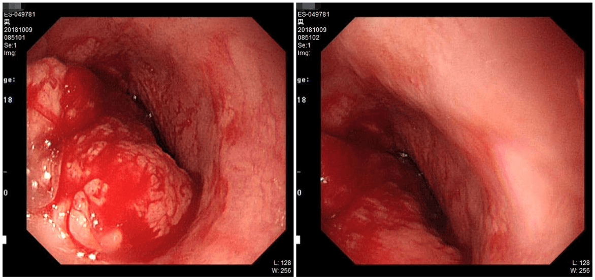 1621842925535255.png 晚期食管癌免疫治疗:雷替曲塞+PD-L1(转)