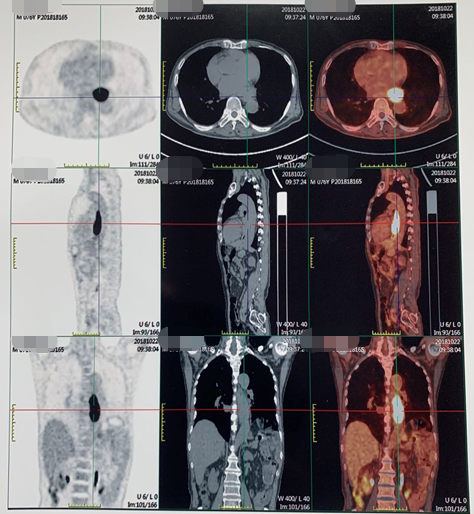 1621843033371773.png 晚期食管癌免疫治疗:雷替曲塞+PD-L1(转)