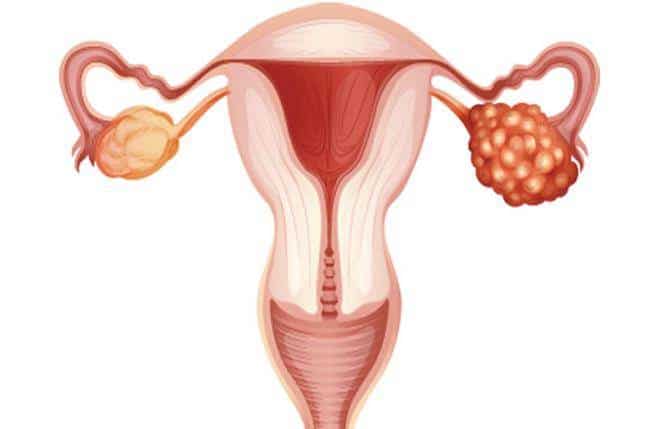 卵巢癌 国内第四个PARP抑制剂帕米帕利(百汇泽®)上市,卵巢癌福音!