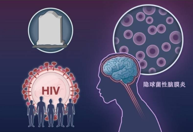 单剂量安必素联合治疗隐球菌性脑膜炎不劣于世界卫生组织推荐疗法